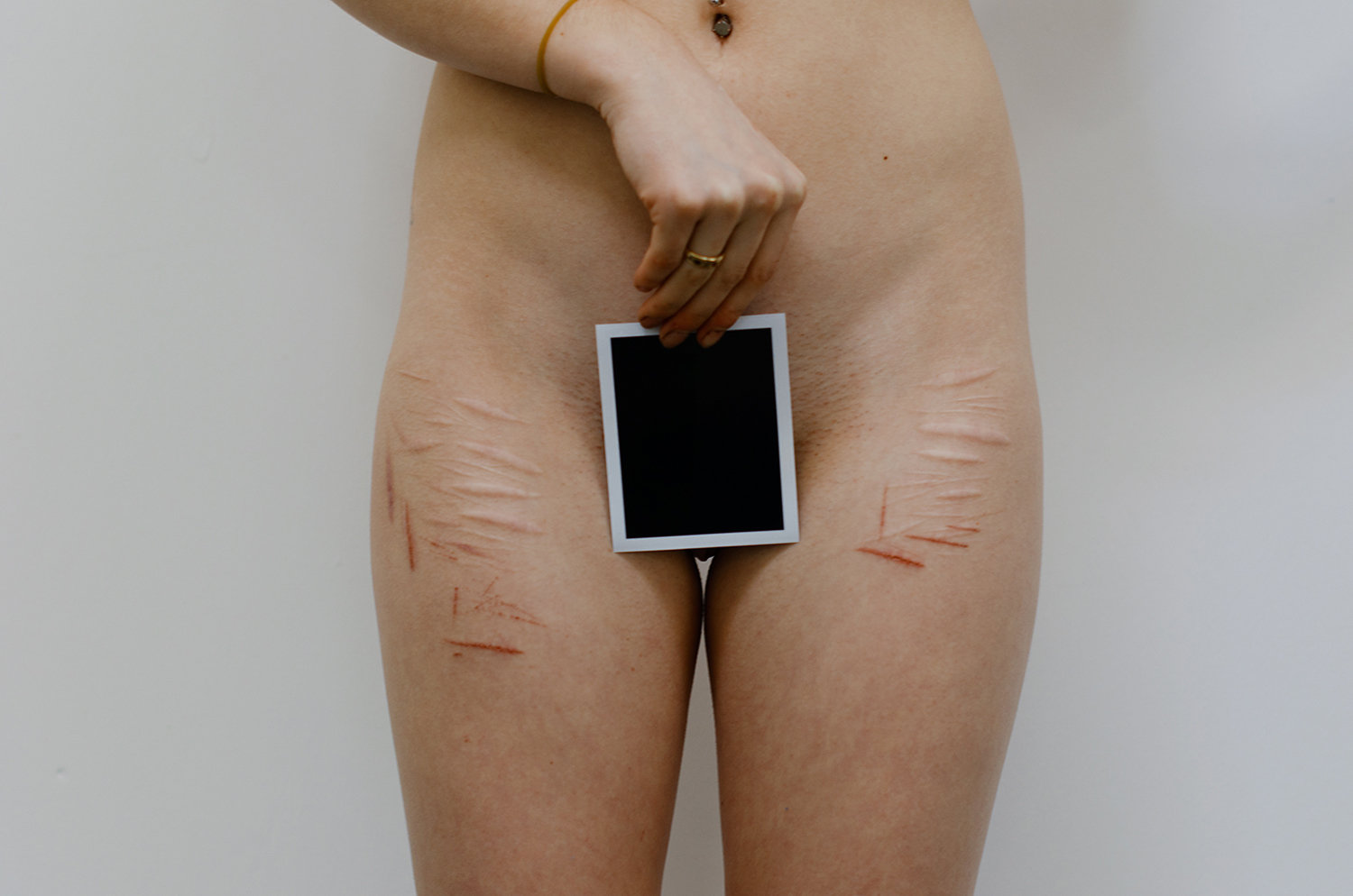 scars, nude model, escape the traumatic memories, photo by headcleaner