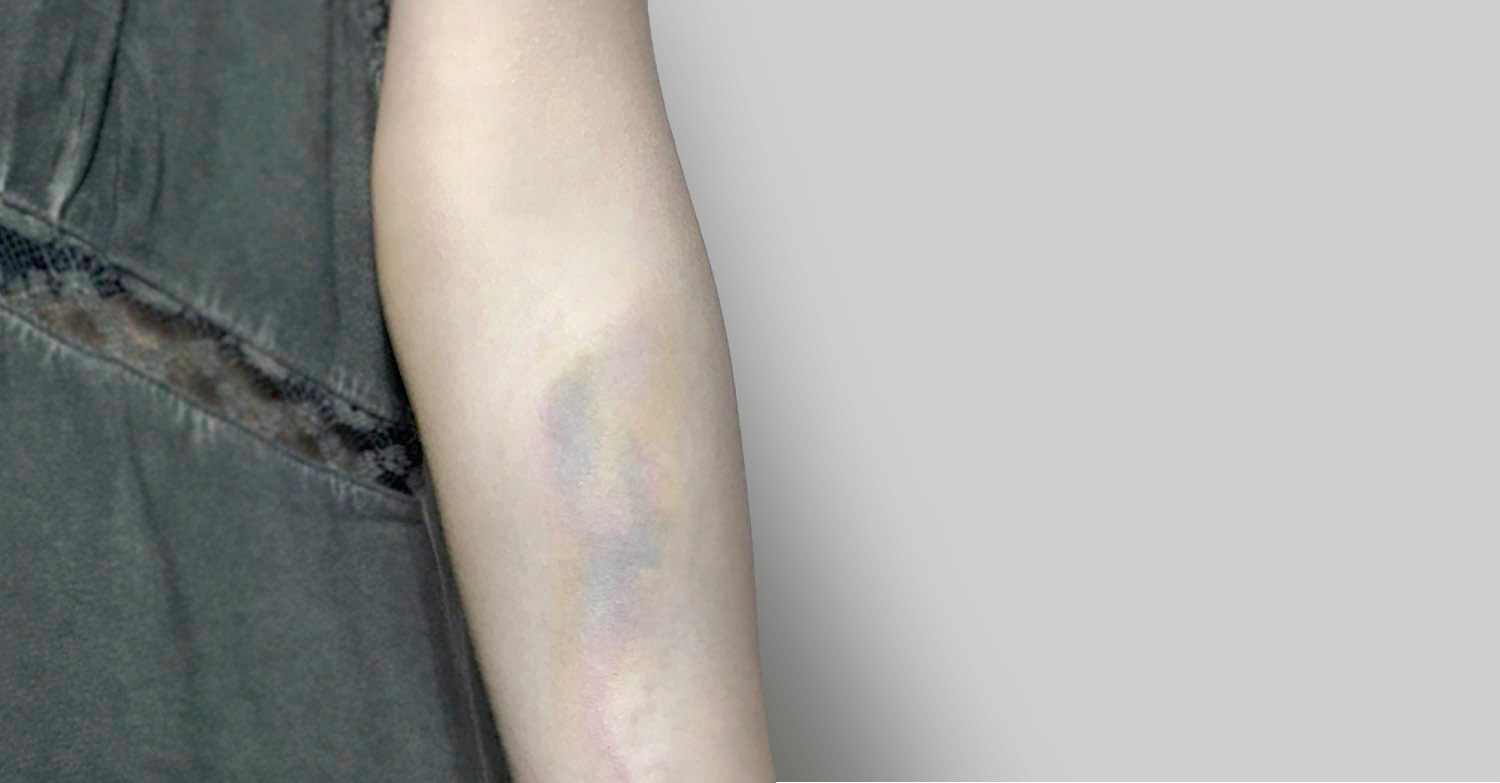 Bruise tattoo by BabyShoe